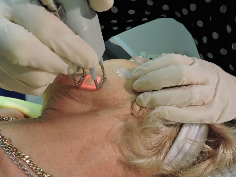 CO2 Fractional Laser (Ablative)