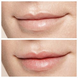 5. Dermal Fillers | Before and After