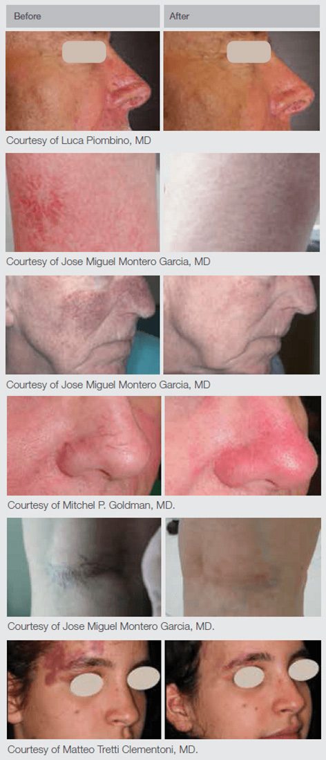 Nd:YAg Laser Skin Treatment Before & After Shots